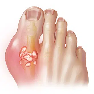 Big toe affected by gout due to high levels of uric acid