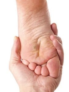 Plantar wart caused by human papillomavirus